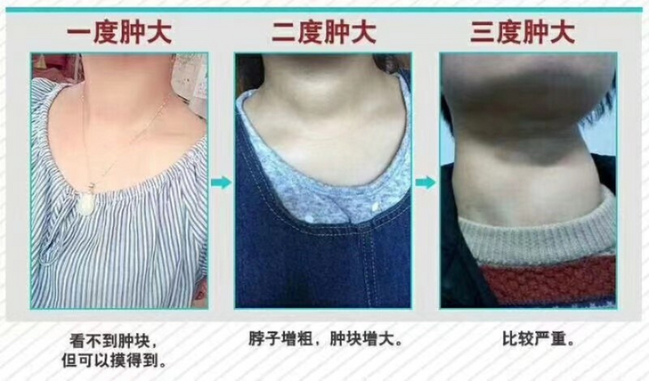 甲状腺肿大的分度有以下三个程度,但是不同的肿大对我们的身体健康都