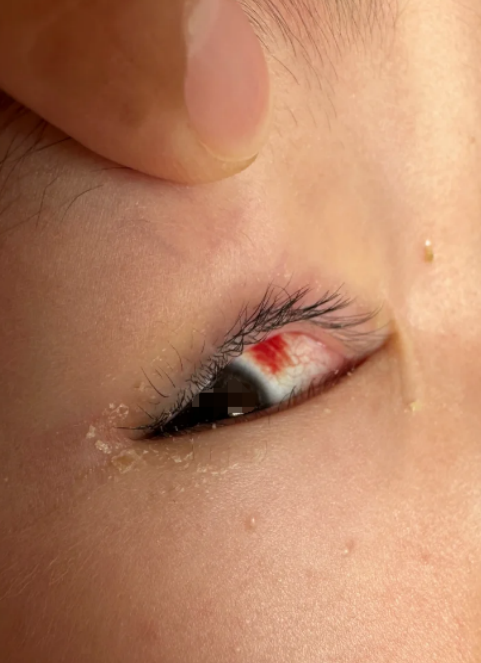 小孩眼睛充血常见原因有结膜炎,过度用眼,干眼病,泪道阻塞和上呼吸