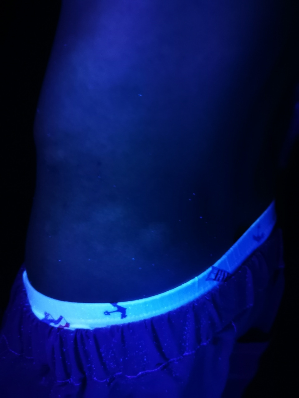 儿子昨天在伍德灯下确诊的白癜风,麻烦大家帮我看看这种斑真的是