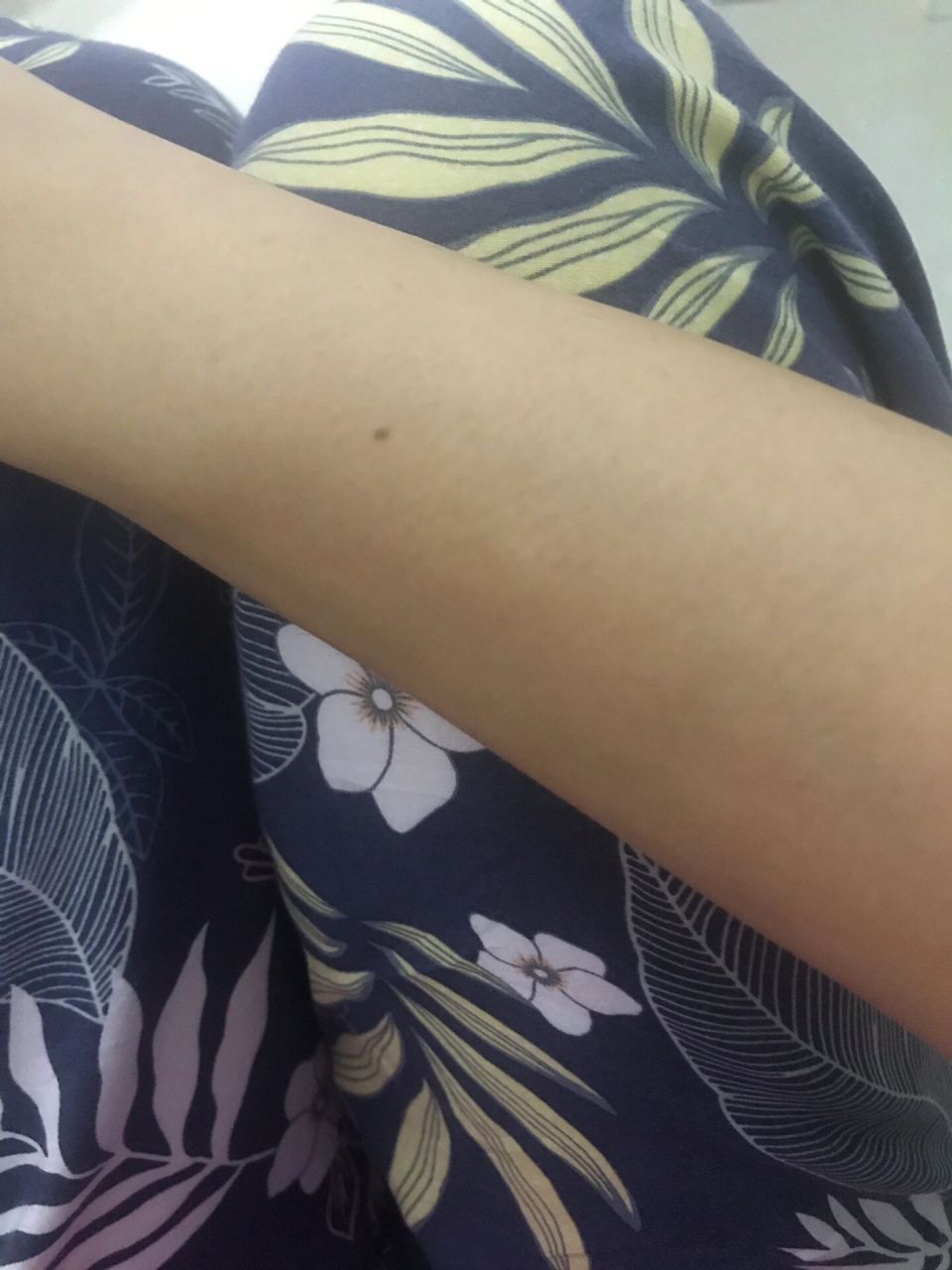 右手臂上这个位置今年又长痣了 以前点掉过两次,好几年没有,现在又长