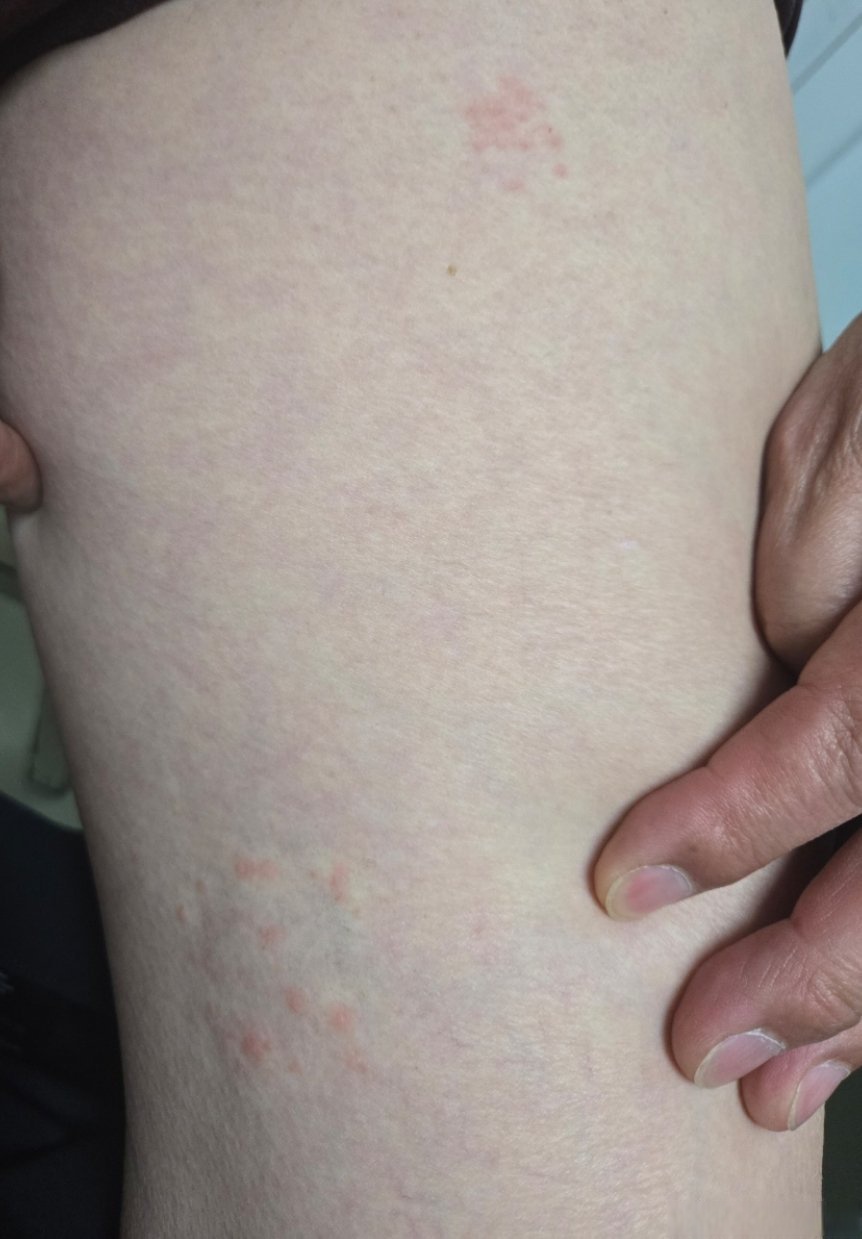 皮肤难题帮帮忙##微博健康护肤月##健闻登顶计划##微博兴趣创作计划