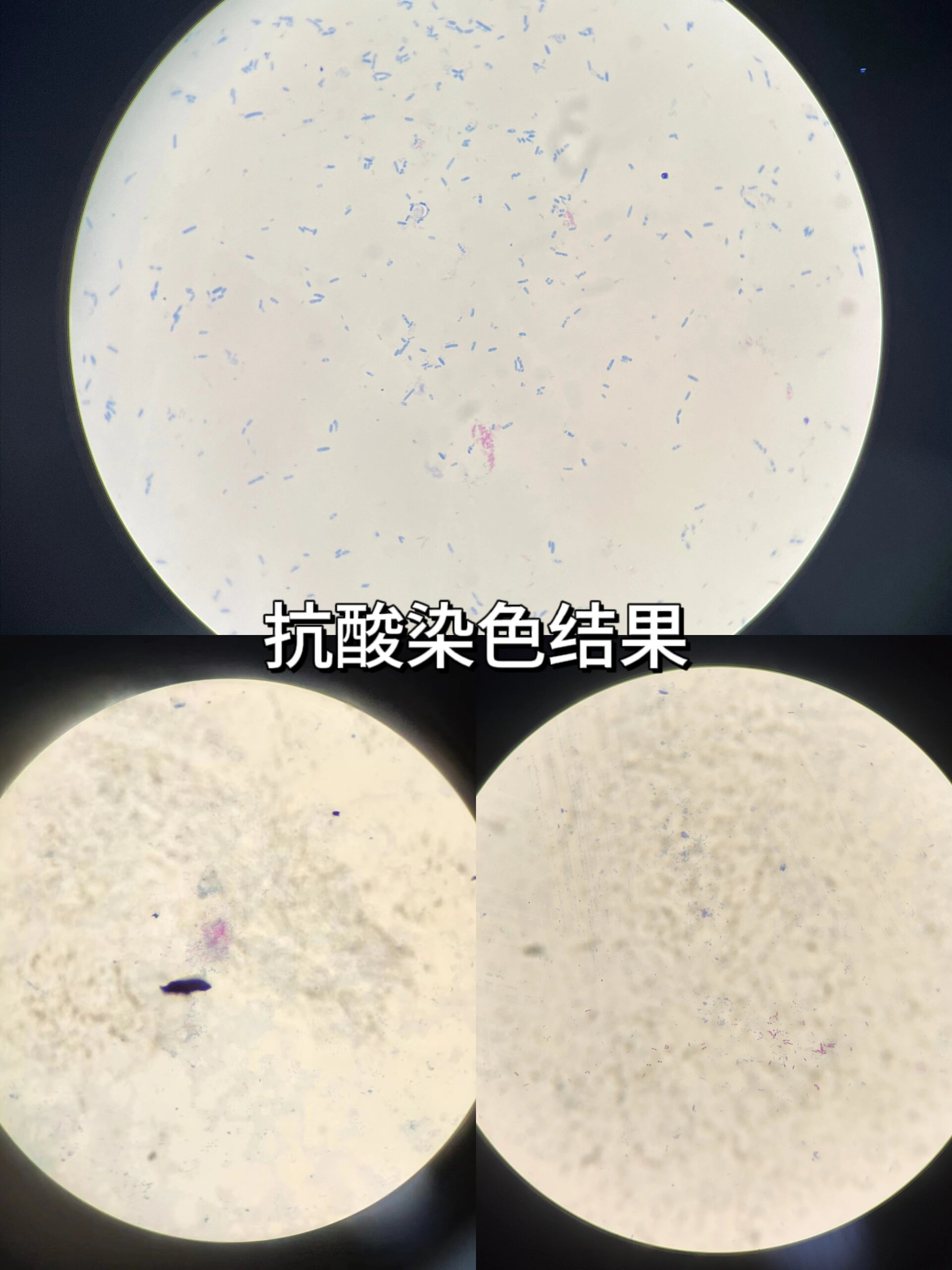 抗酸染色图片