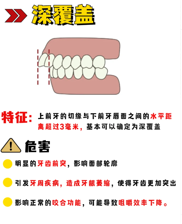 深覆盖和深覆合图解图片