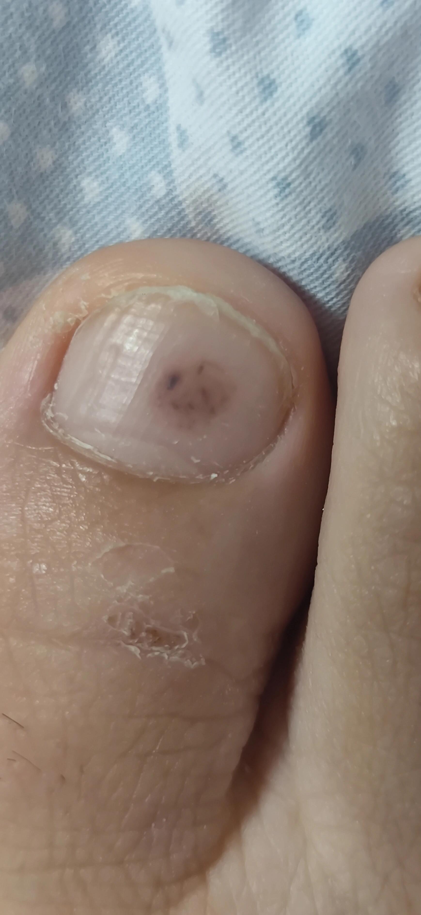 大脚趾里面长了黑色的斑点,这是什么啊