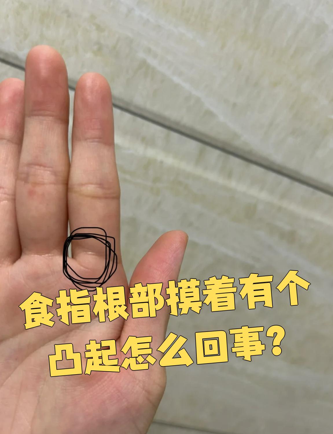 食指根部摸到凸起,常见原因有狭窄性腱鞘炎,骨质增生,腱鞘囊肿,滑膜