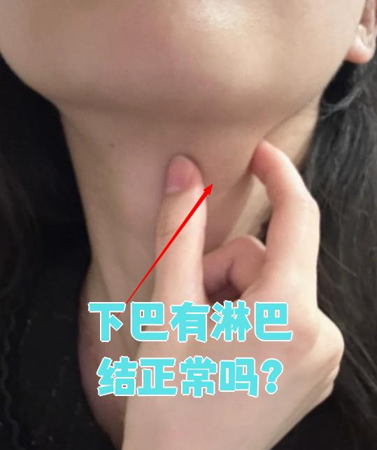 颈部总共有6个区域存在淋巴结,每个区域的淋巴结数量和大小都不一样