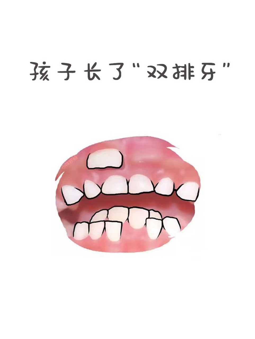 07"双排牙"临床上我们称为"乳牙滞留".