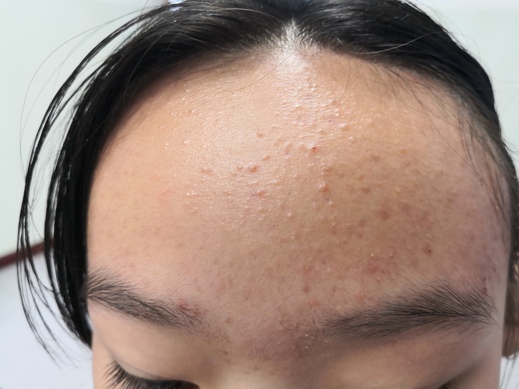 痤疮##青春痘##解决皮肤问题专注皮肤美容# 可以使用药物外用治疗.