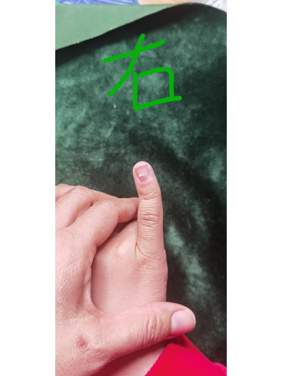 早上问了我罗神,放心了 	 1-我手也弯,算是遗传 2-小指弯曲不影响功能
