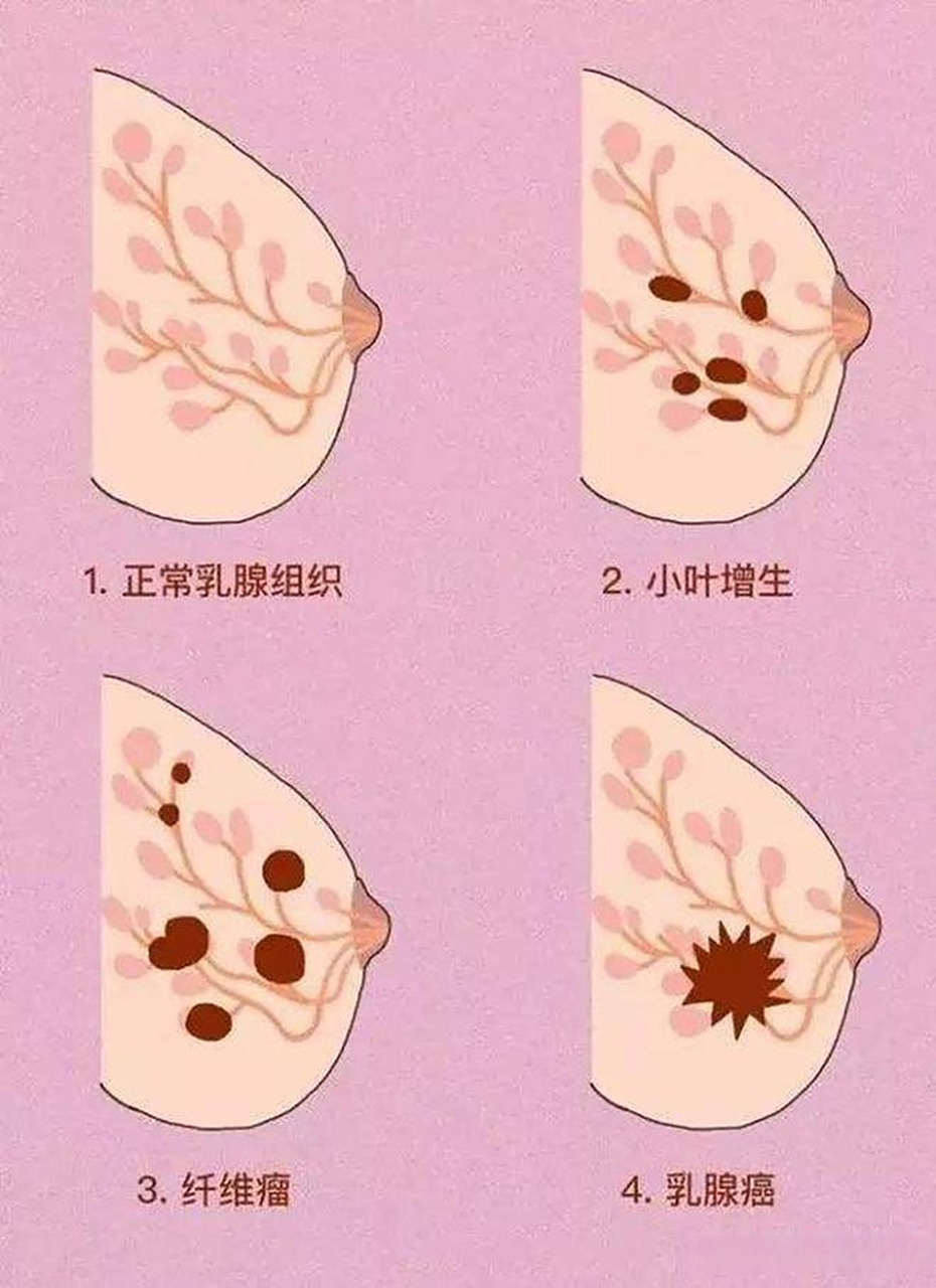 乳腺增生与乳腺癌的发病关系?