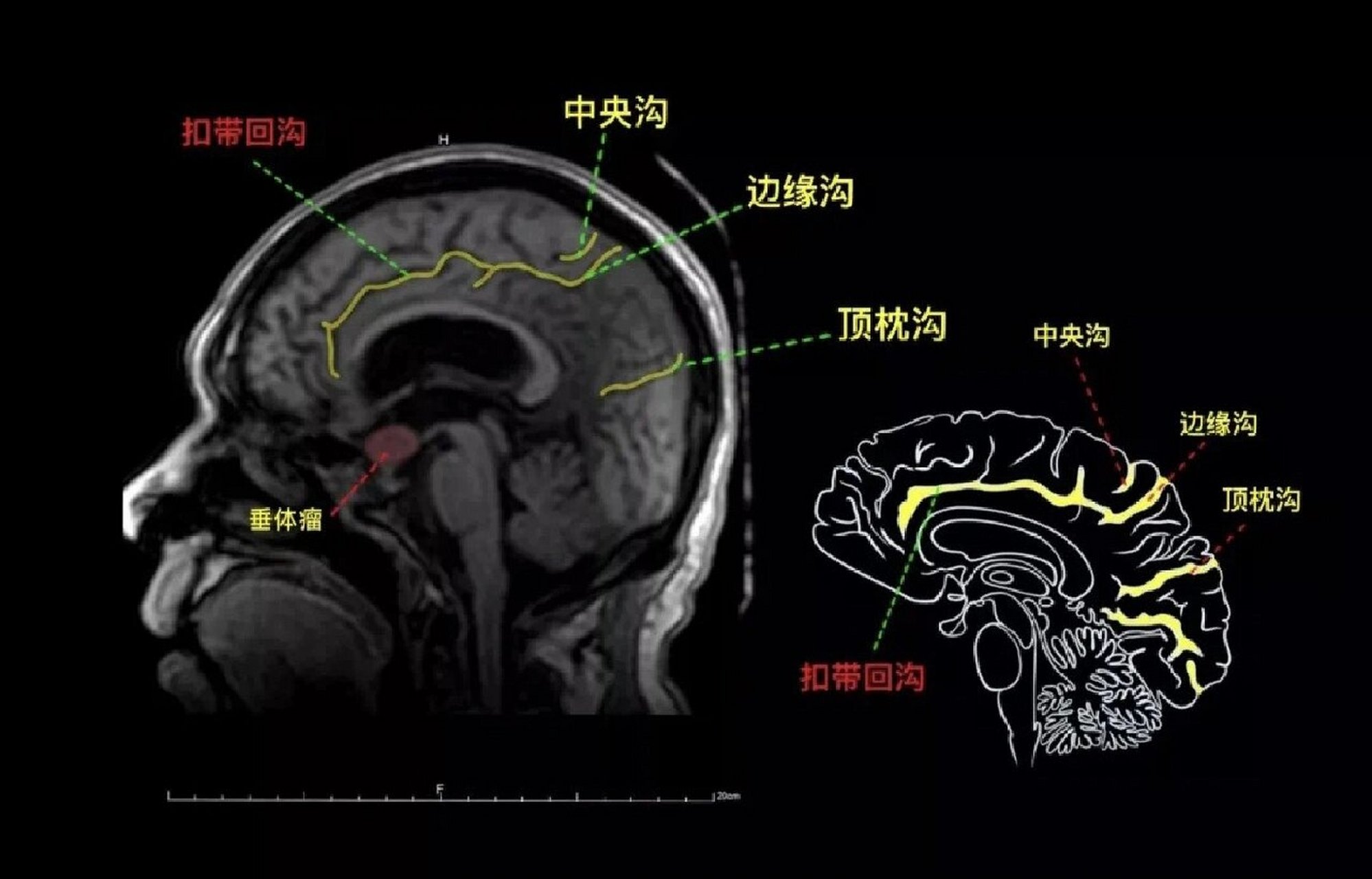 脑部矢状位解剖图图片