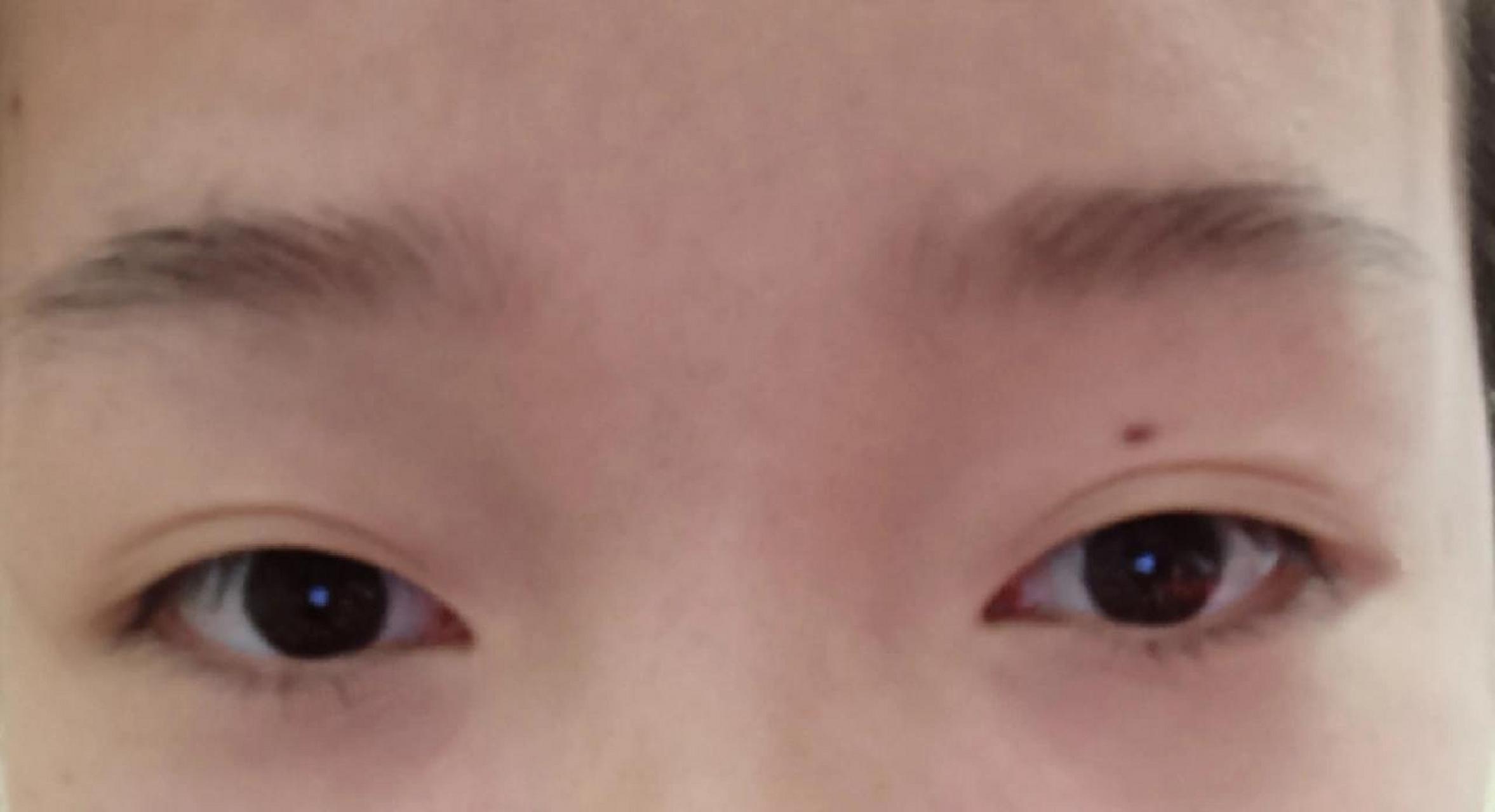 右眼皮突然长痣是代表什么