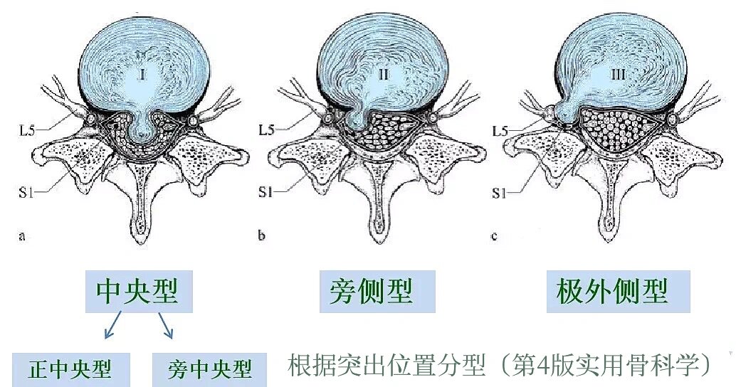 髓核凸出图片