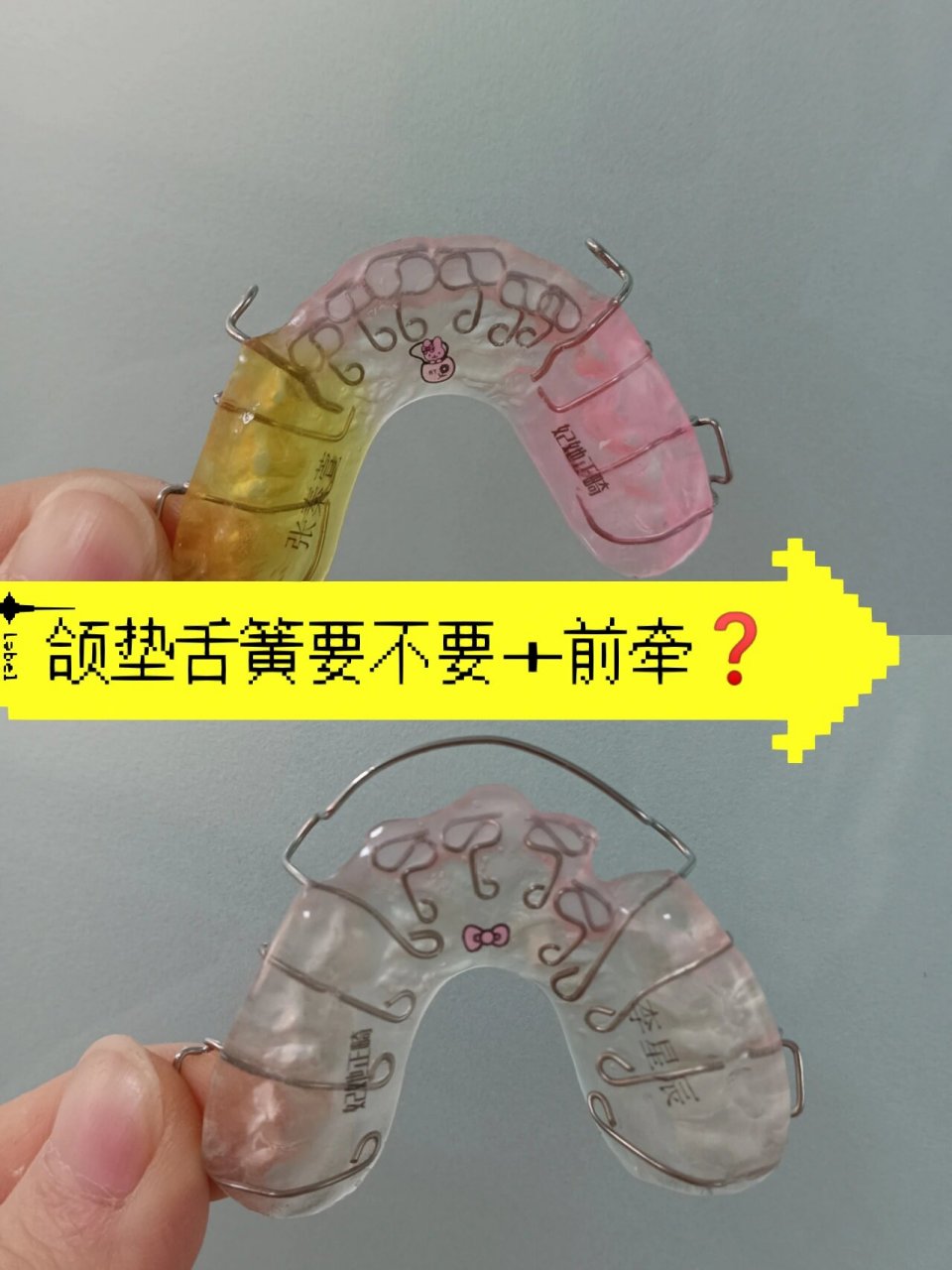 舌簧颌垫矫治器or舌簧颌垫前牵如何选择❓ 颌垫舌簧矫治器,用于矫正