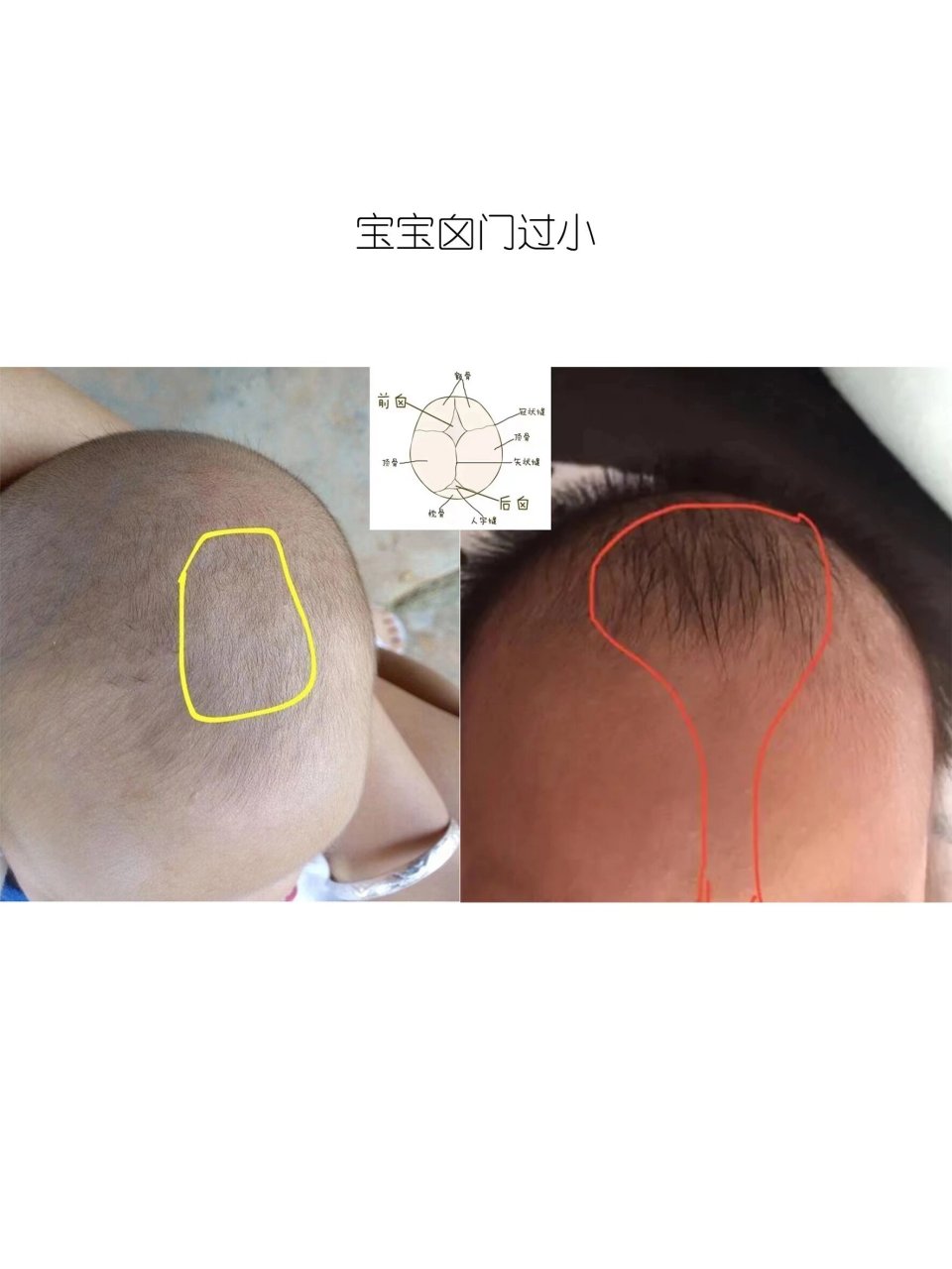 关于宝宝的囟门(狭小 过大 迟闭 早闭) 在宝宝头的顶部和枕后部有两个