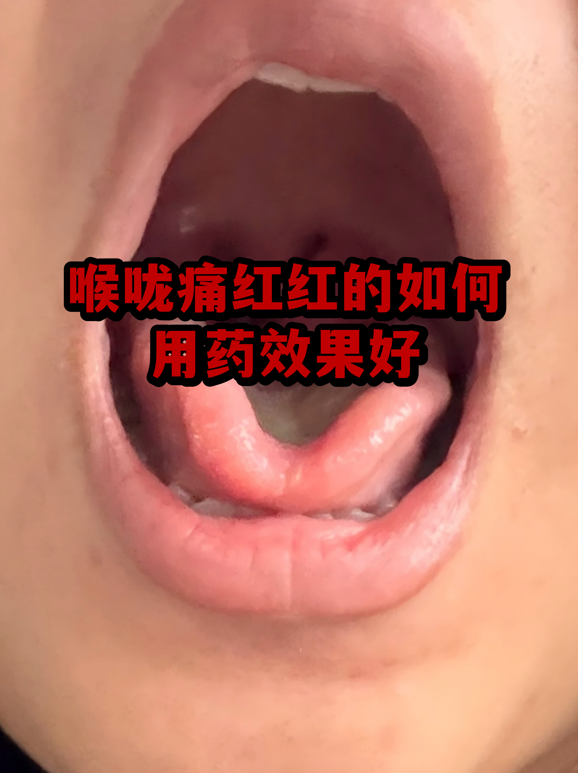  病毒引起的喉咙痛吃什么药管用呢(病毒引起的喉咙疼吃什么药)