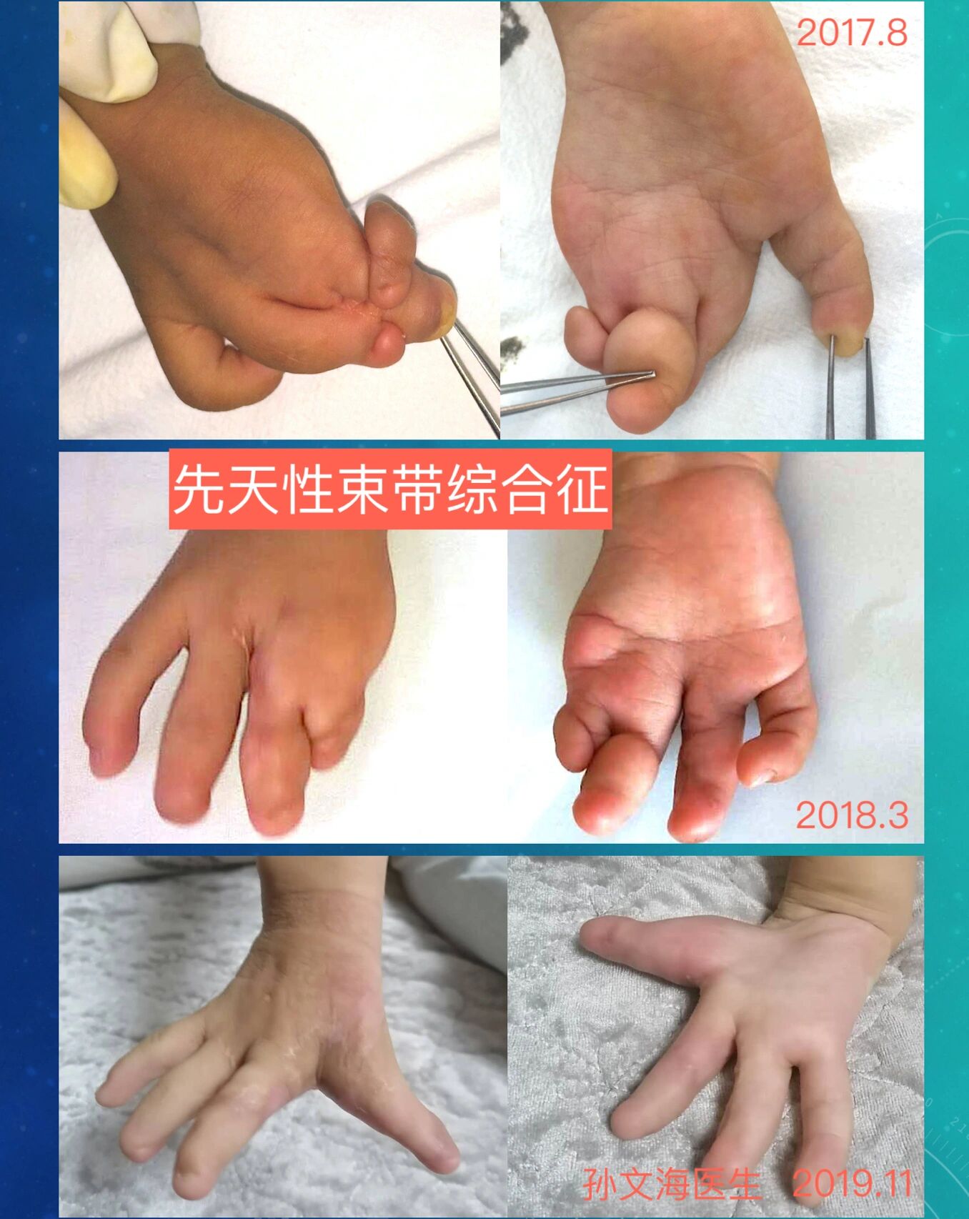 束带综合征95