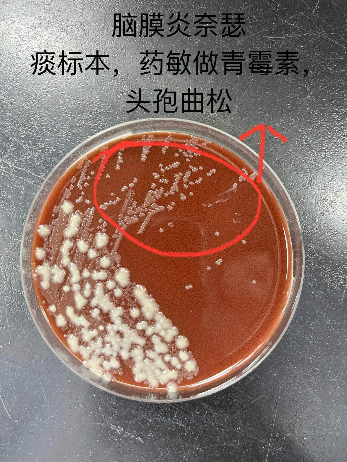 脑膜炎奈瑟菌