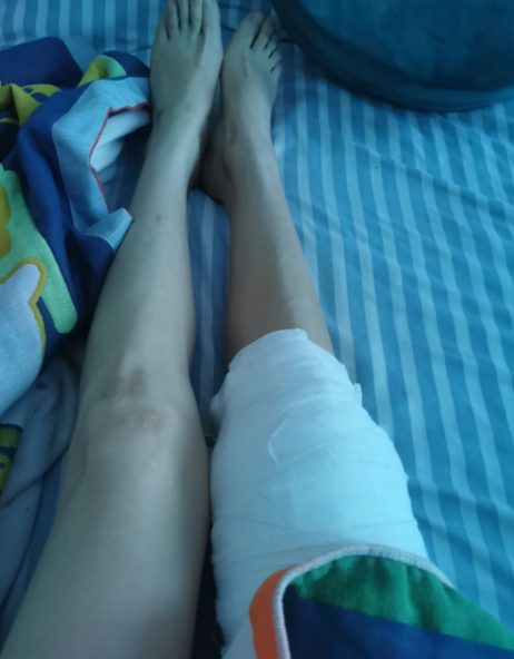 如果老人摔伤后拍x光发现是不全骨折或者简单的裂纹骨折,骨头没有