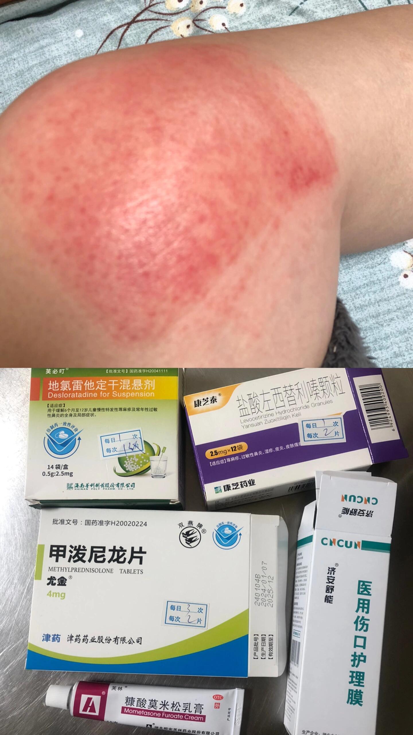 贴膏药引起的过敏 奇痒无比 去了皮肤医院,医生给开的一堆药 我怀疑她
