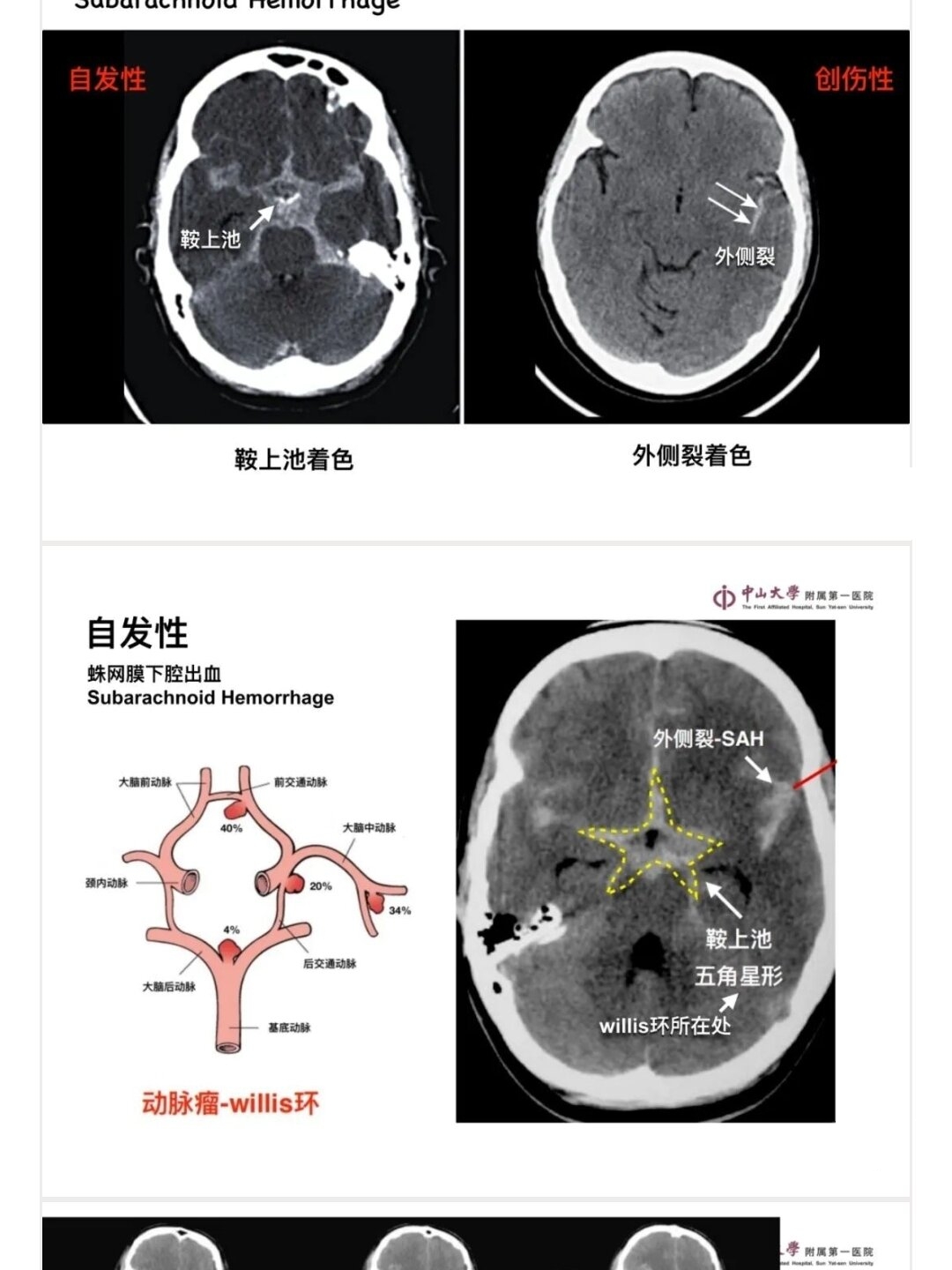 脑干梗死CT图片