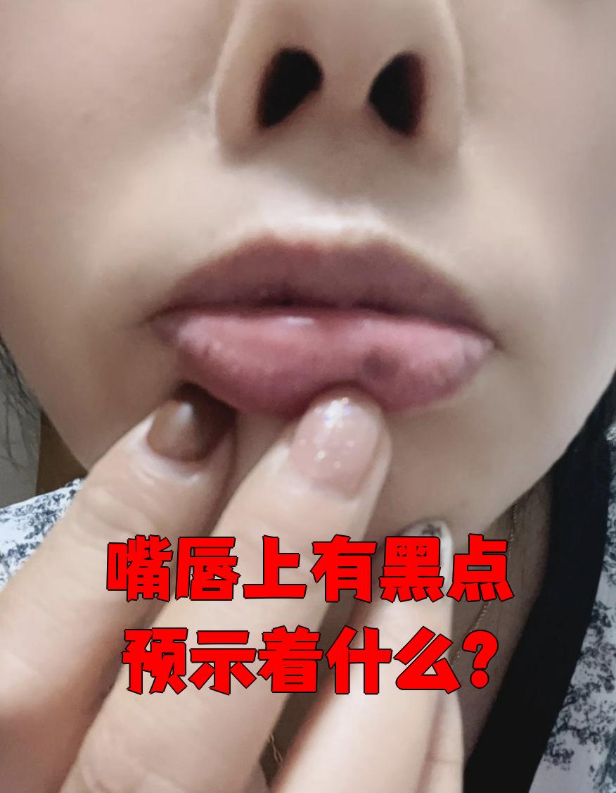 嘴唇上有黑点预示着什么?