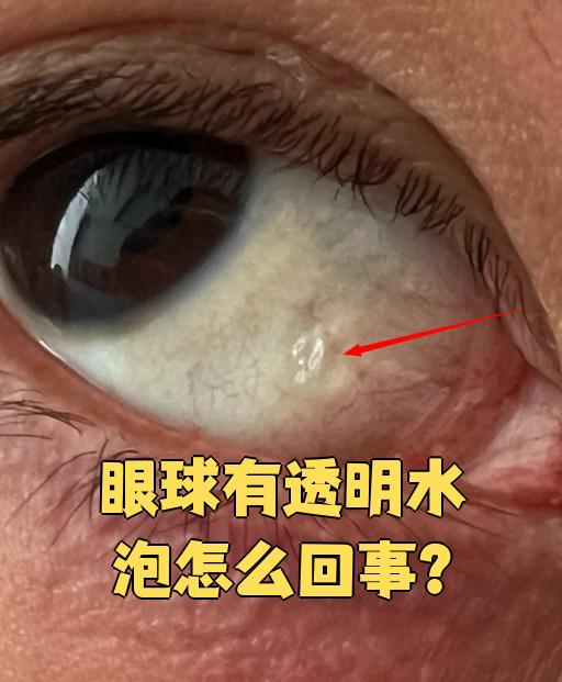 眼球上出现透明水泡,可能是结膜水肿,水泡性结膜炎或淋巴管堵塞引起