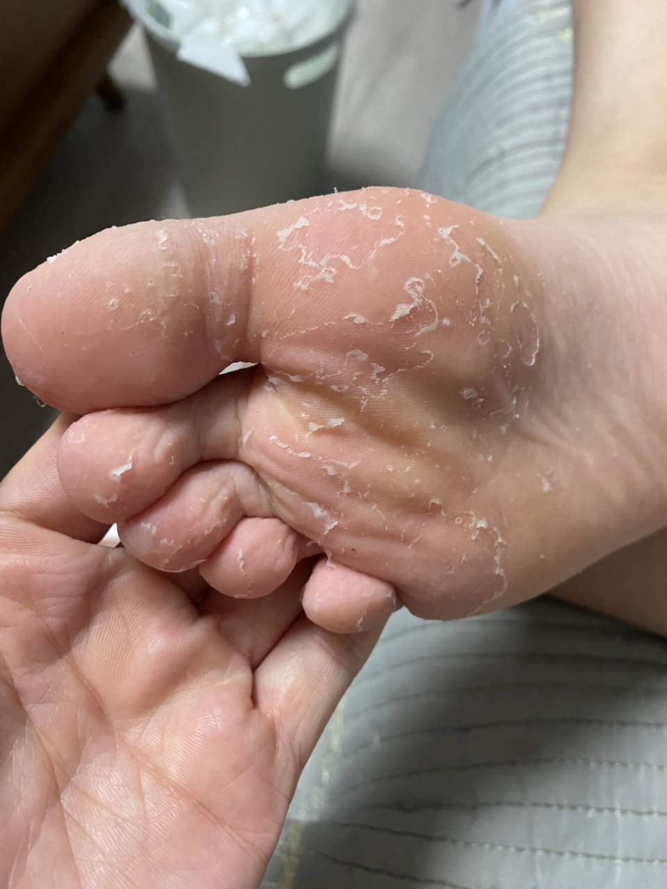 三岁小脚就开始起皮,最开始没这么多,今年就九岁更严重了.