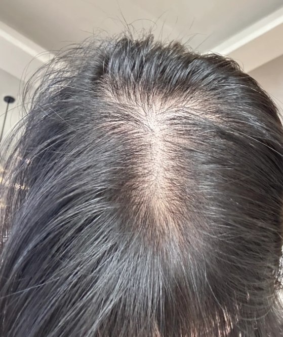 如何应对脱发困扰：最新治疗方式盘点