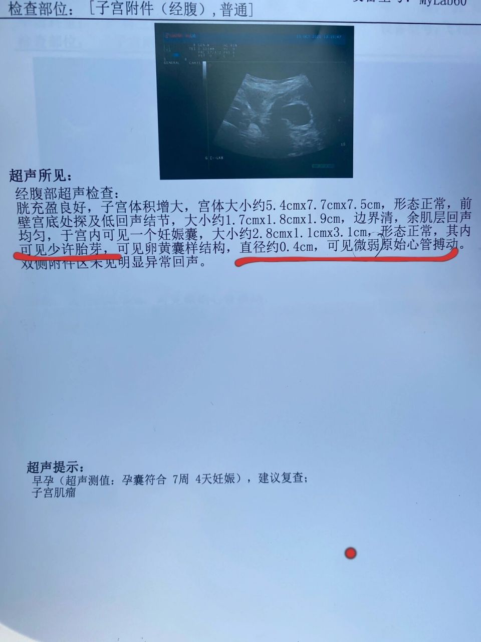 可见微弱原始心管搏动 从怀孕到现在,一直提心吊胆.