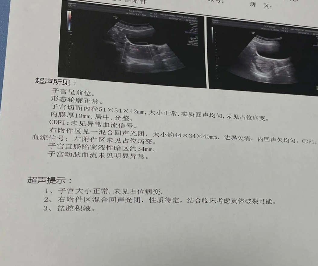 卵巢黄体囊肿是排卵后形成的囊性结构