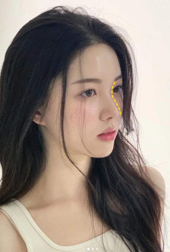 一般都会选择注射鼻,隆量很克制,少量多次叠加