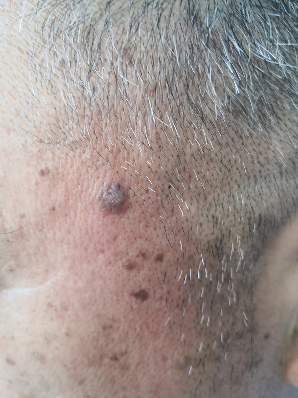 面部老年斑脂溢性角化,激光治疗去除可以#解决皮肤问题专注皮肤美容