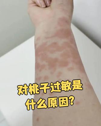 对桃子过敏主要有两个原因:一是对桃子表面的绒毛过敏,二是对果肉里