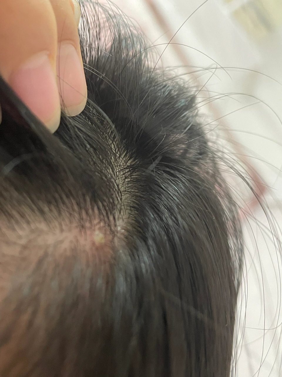 头皮上长了白色肉疙瘩 是怎么了 有姐妹知道吗 按压