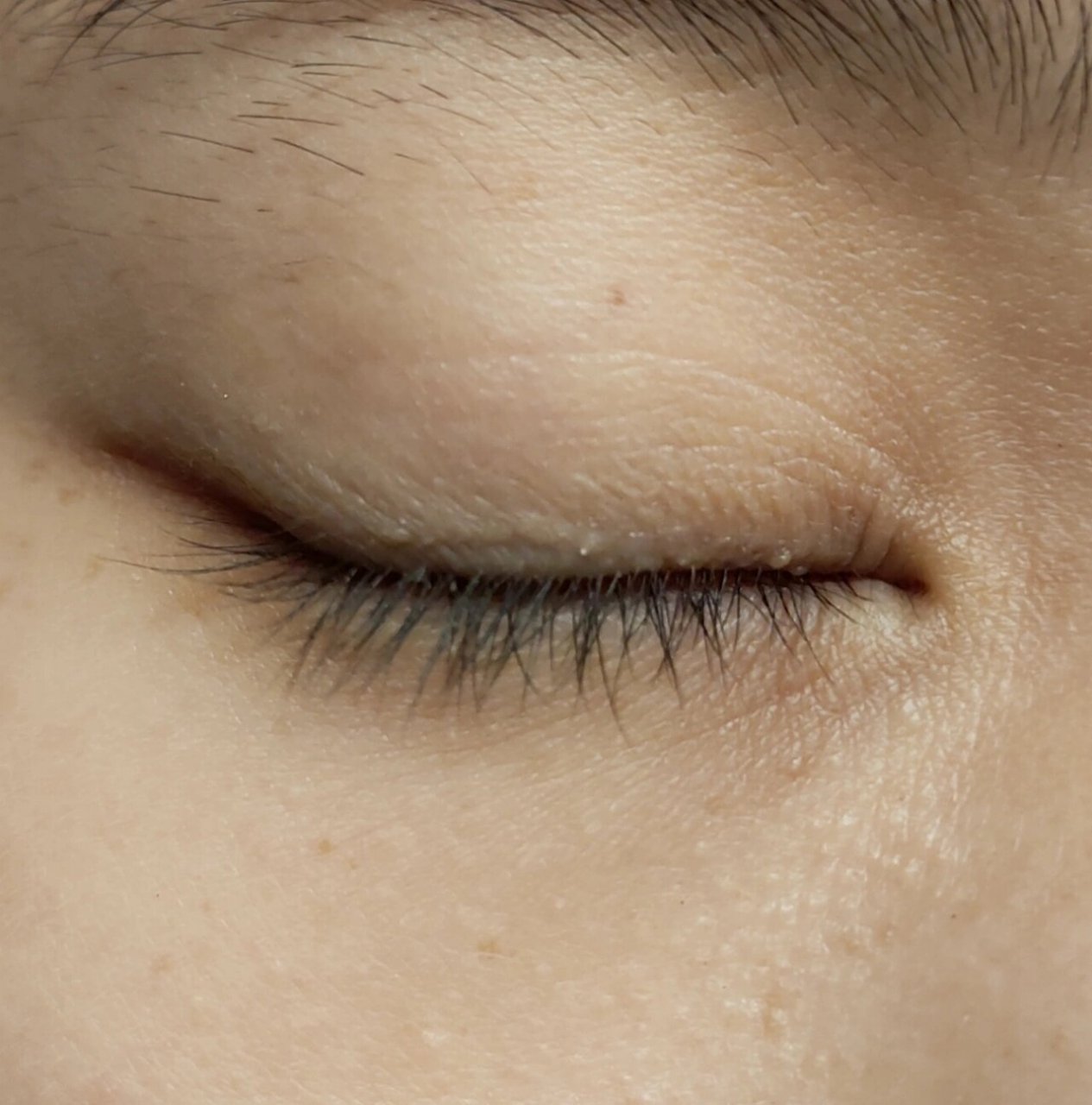 求助眼睫毛根部眼皮长的疙瘩到底是什么 眼睫毛根部很早之前开始长一