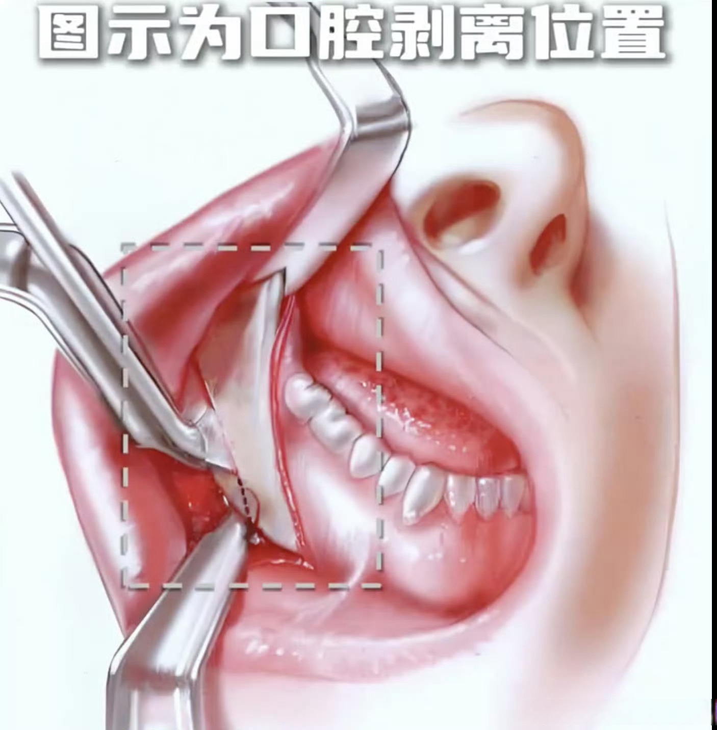 开口于什么位置下颌角磨骨切口位置下颌下腺导管口腔腮腺导管口照片
