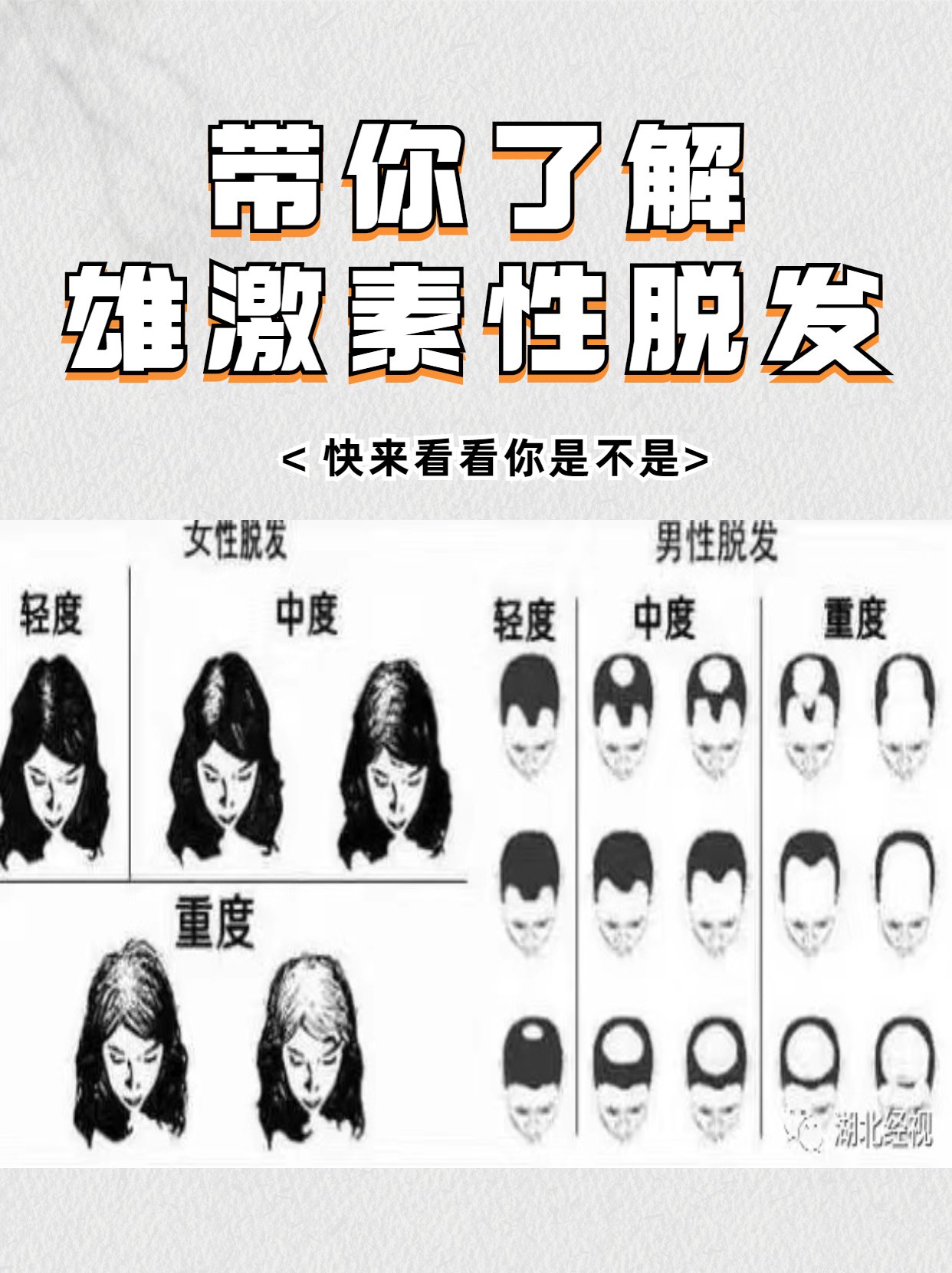 带你了解雄激素脱发!