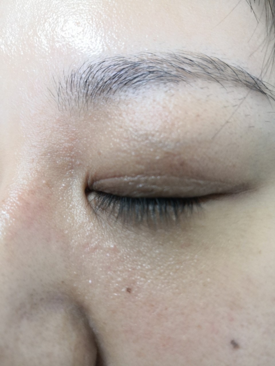 眼睑及周围的粟丘疹和汗管瘤症状#解决皮肤问题专注皮肤美容##激光