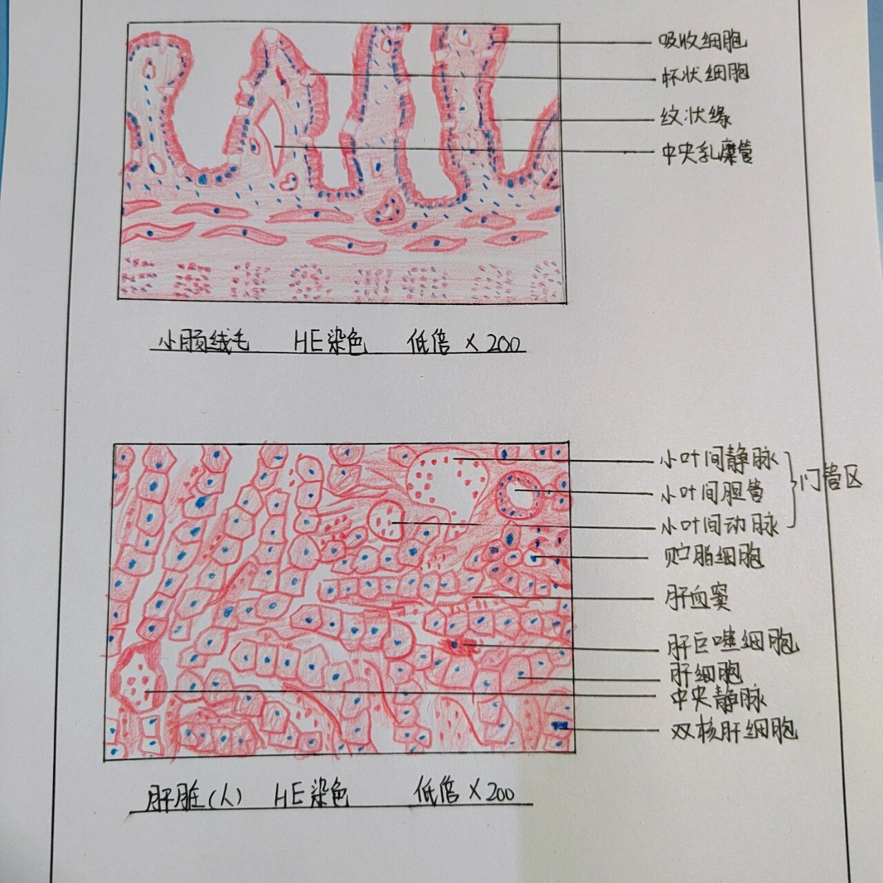 绒毛膜癌病理手绘图图片