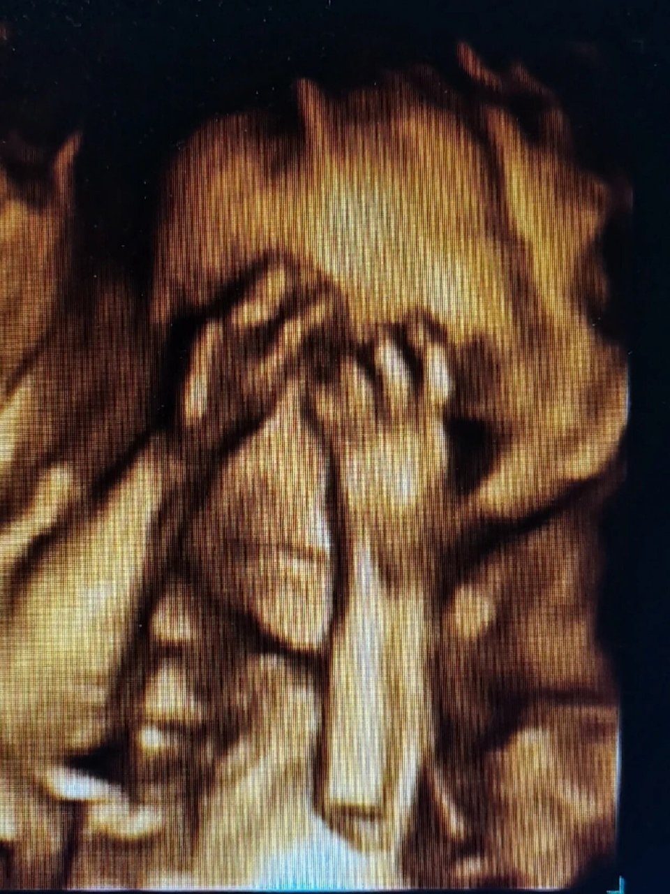 胎儿鼻骨缺失或发育不良怎么办 鼻骨缺失或发育不良的诊断标准:鼻骨未