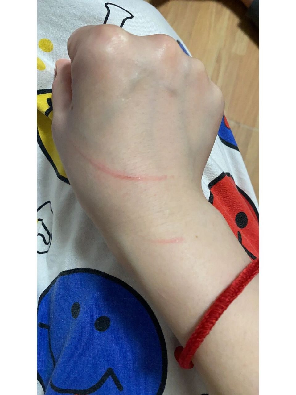 昨晚被家中2个多月的幼猫抓破皮了,刚接回来还没有打疫苗驱虫,需要打