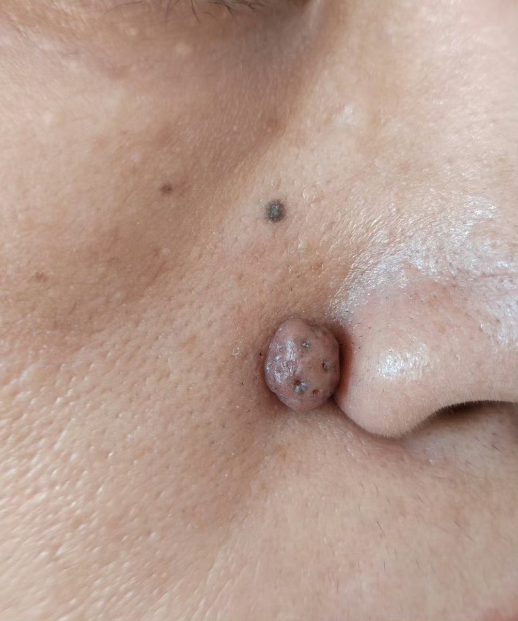 色素痣激光治疗去除前后对比图#解决皮肤问题专注皮肤美容##色素痣