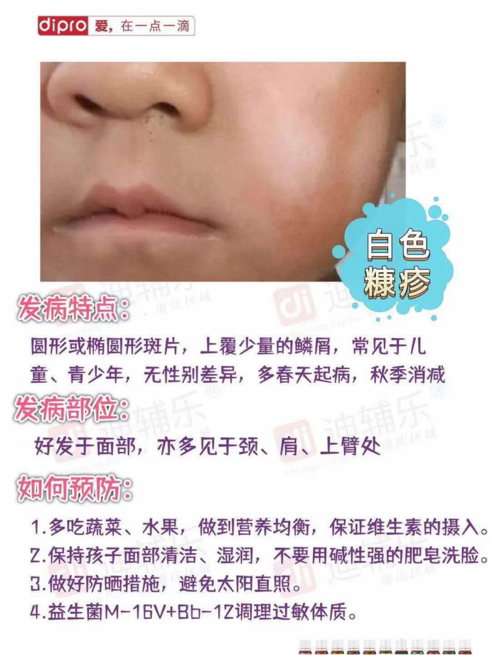 ‭‮乐辅迪‬‬®健康小知识 ‭‮色白‬‬糠疹