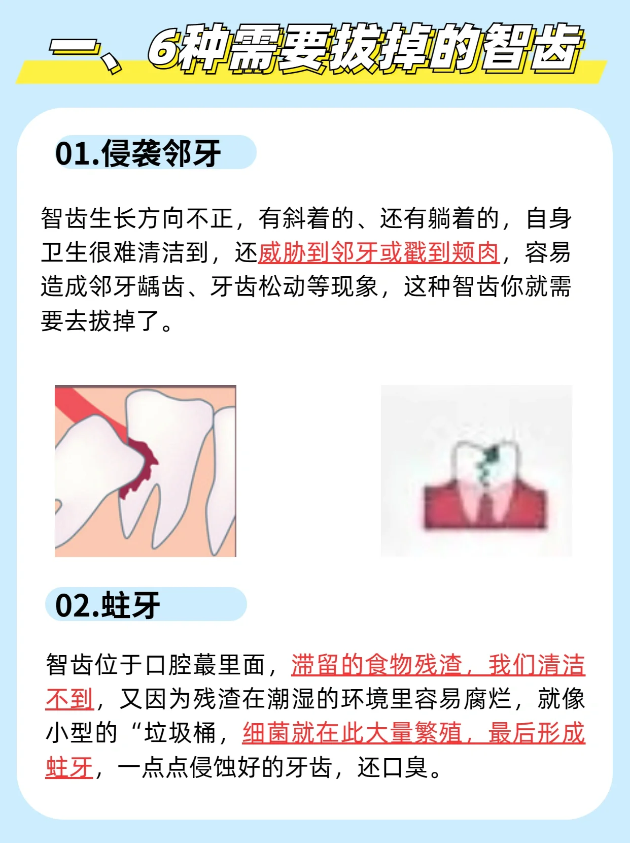 但如果智齿出现了一下六种,不拔掉会影响其他的牙齿