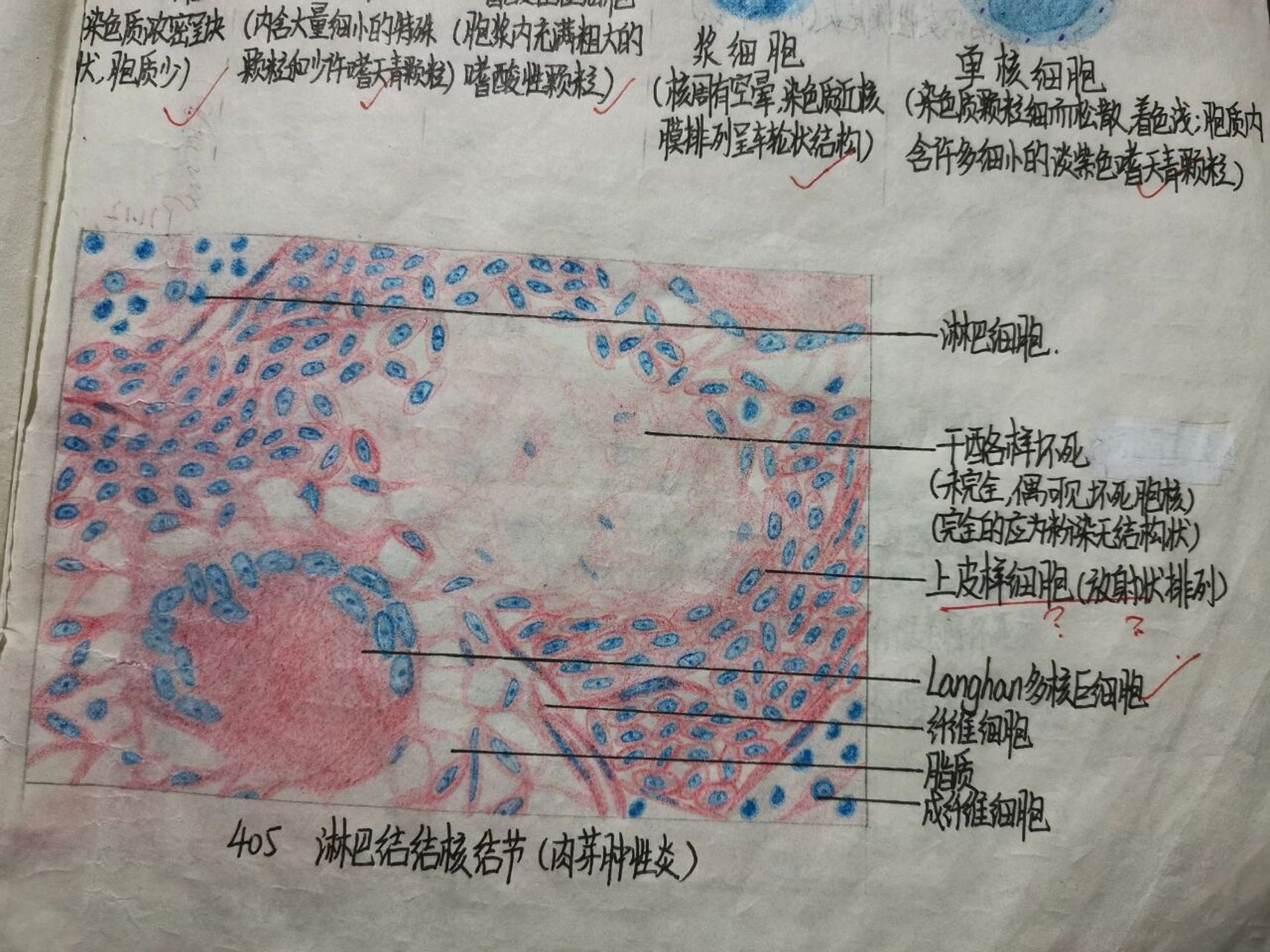 病理红蓝铅笔手绘图——炎症 99炎细胞 99淋巴结结核结节(肉芽肿