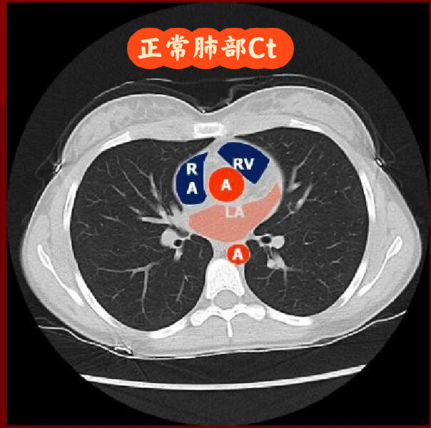 新冠肺炎肺部影像图片图片