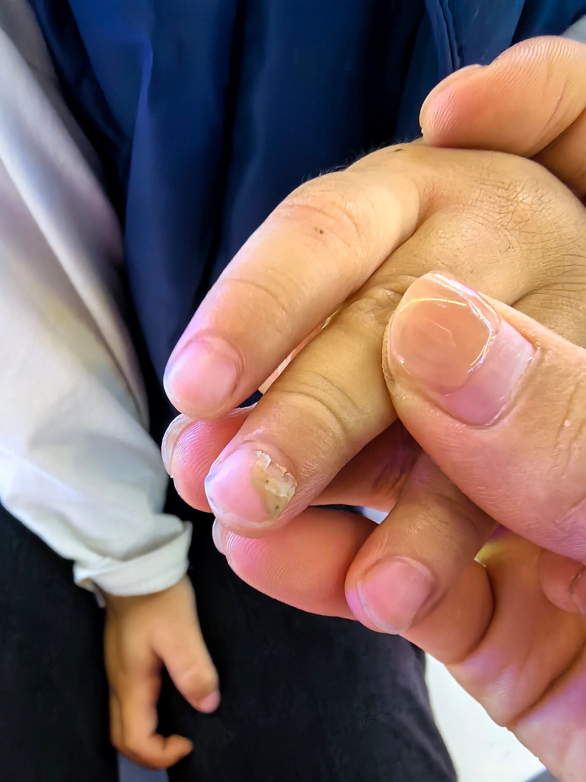 小孩指甲从根部脱落是咋回事