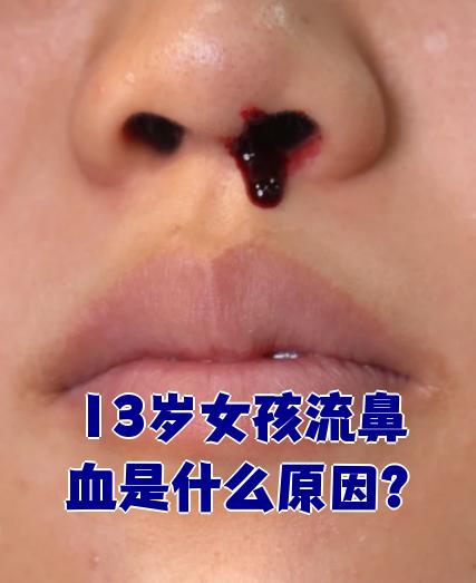 14岁初中生为什么经常流鼻血的原因百科在线 14岁初中生为什么经常流鼻血的原因百科在线
