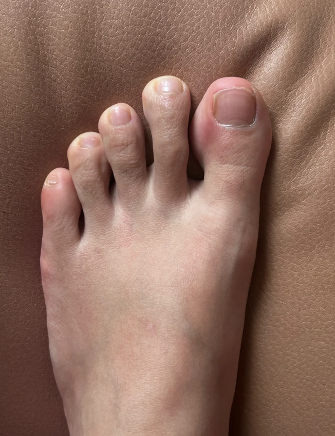 左脚大拇指关节疼痛常见原因包括骨折,关节炎,风湿和痛风